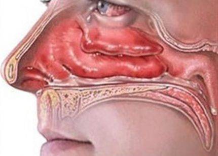 Un humidificateur aide-t-il en cas d'allergies : recommandations pour les personnes allergiques et asthmatiques