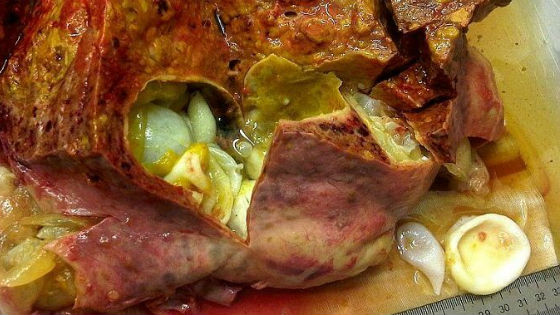 9 signes subtils que les parasites vivent en vous