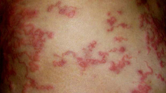 9 signes subtils que les parasites vivent en vous