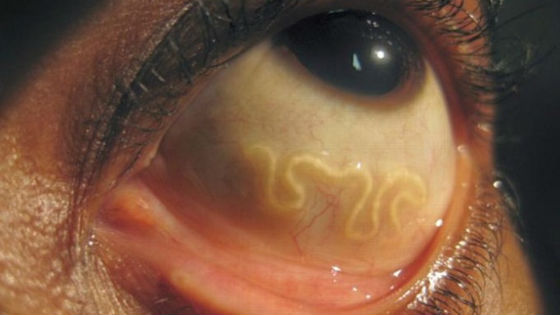 9 signes subtils que les parasites vivent en vous